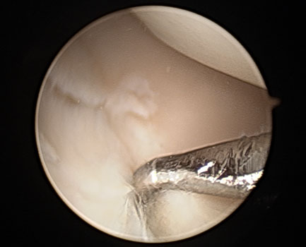 knee arthroscopy